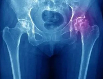Асептический некроз тазобедренного сустава: диагностика и лечение